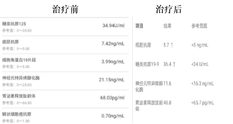 什么是NK-T细胞免疫疗法