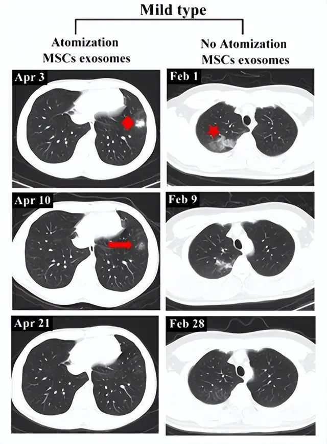 国务院联防联控新闻发布会：干细胞可以有效降低新冠病毒在患者体内引发的剧烈炎症反应