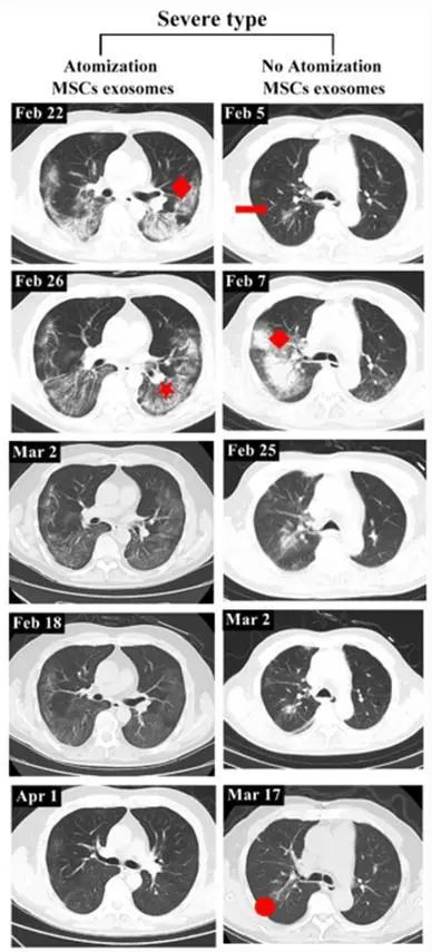 国务院联防联控新闻发布会：干细胞可以有效降低新冠病毒在患者体内引发的剧烈炎症反应