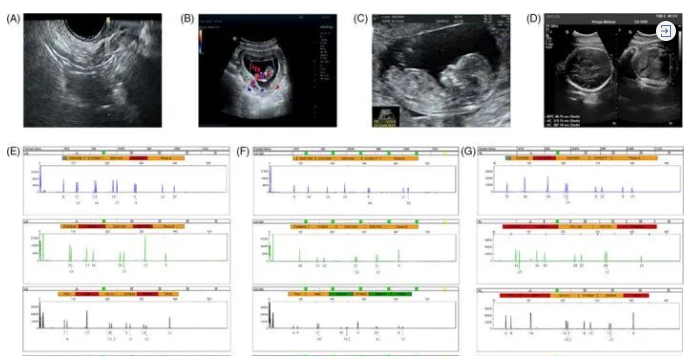 干细胞治疗61名卵巢早衰患者的临床结果分析