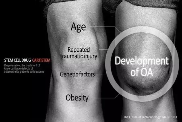 临床试验表明：干细胞可有效改善骨关节炎，让骨关节炎患者告别疼痛