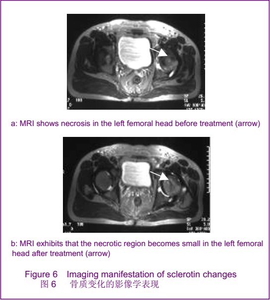 干细胞修复关节炎-关节软骨再生