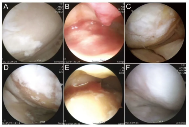 干细胞可提升半月板损伤修复和愈合速度