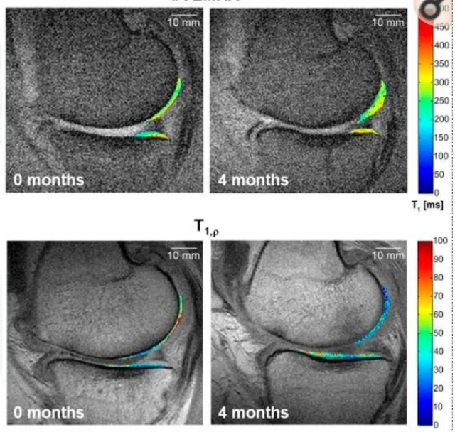 干细胞可提升半月板损伤修复和愈合速度