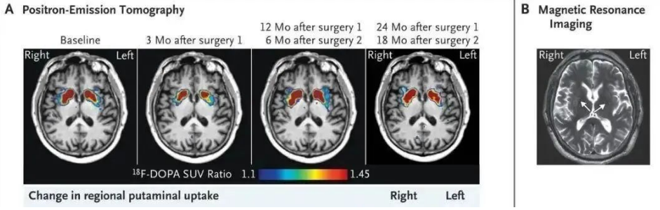 干细胞疗法为帕金森患者带来新希望