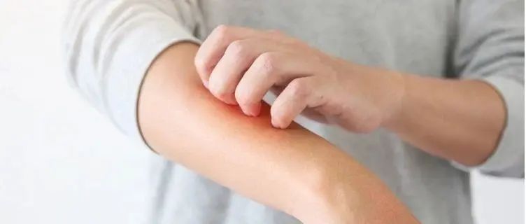 干细胞治疗特应性皮炎案例