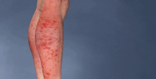 干细胞治疗特应性皮炎案例