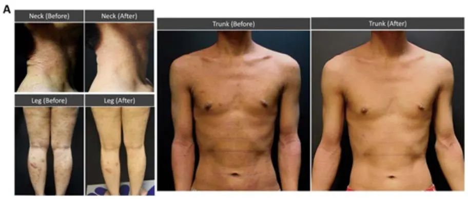 干细胞治疗特应性皮炎案例