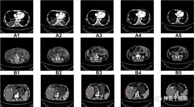 体内NK细胞的数量和活性是人体健康的重要保障