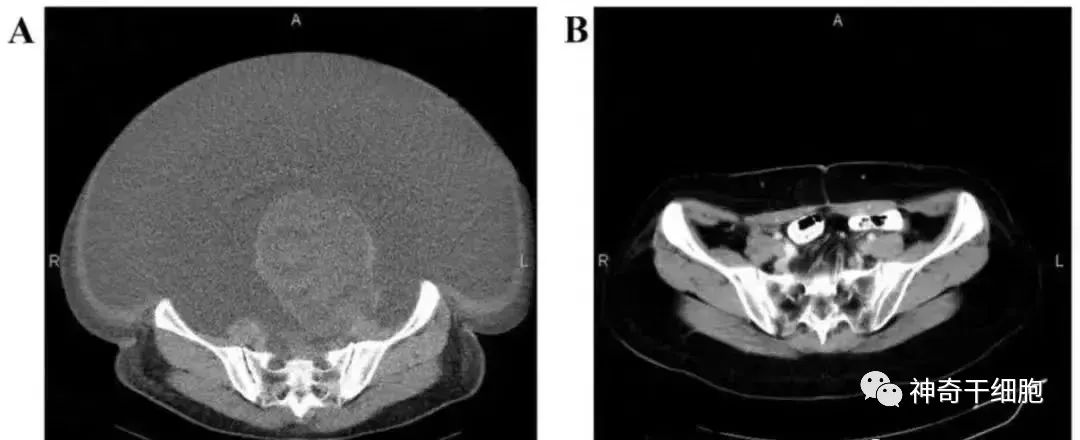 体内NK细胞的数量和活性是人体健康的重要保障