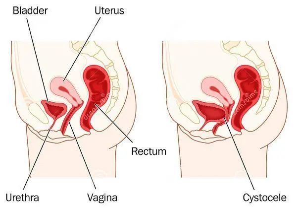 干细胞治疗压力性尿失禁SUI再现潜力
