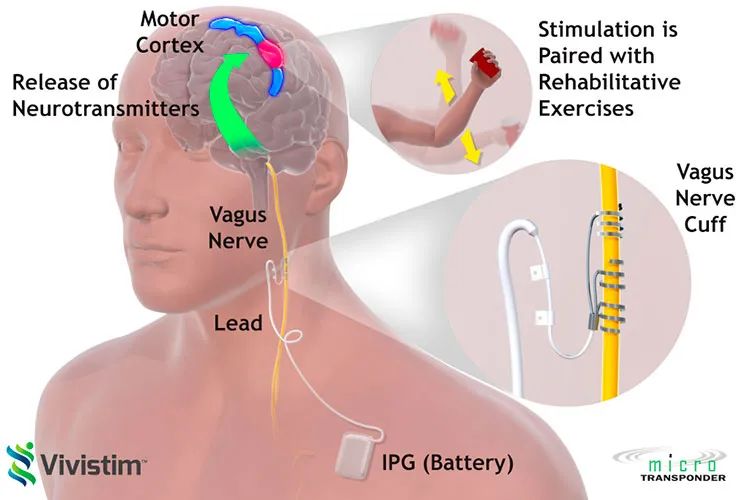 迷走神经刺激疗法对脑卒中康复的价值