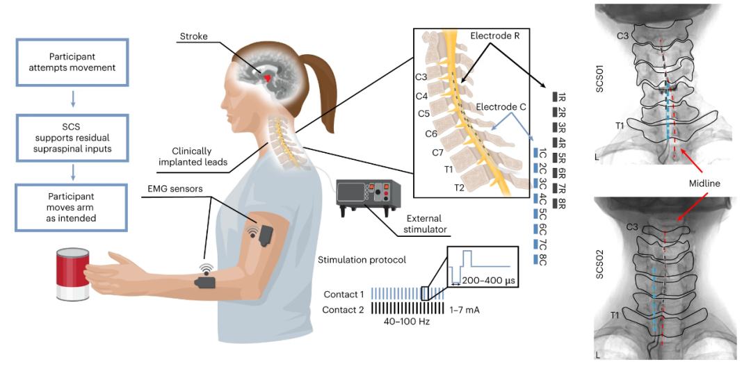 脊髓电刺激有助于脑卒中患者的上肢康复