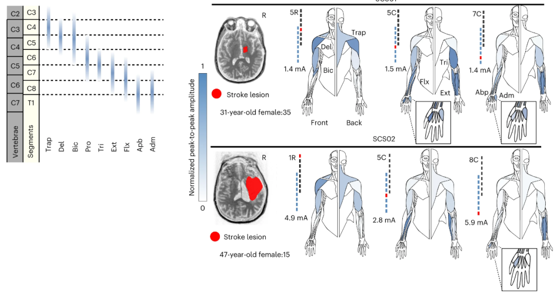 脊髓电刺激有助于脑卒中患者的上肢康复