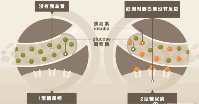 研究表明：间充质干细胞MSCs可以减少2型糖尿病外源性胰岛素需求