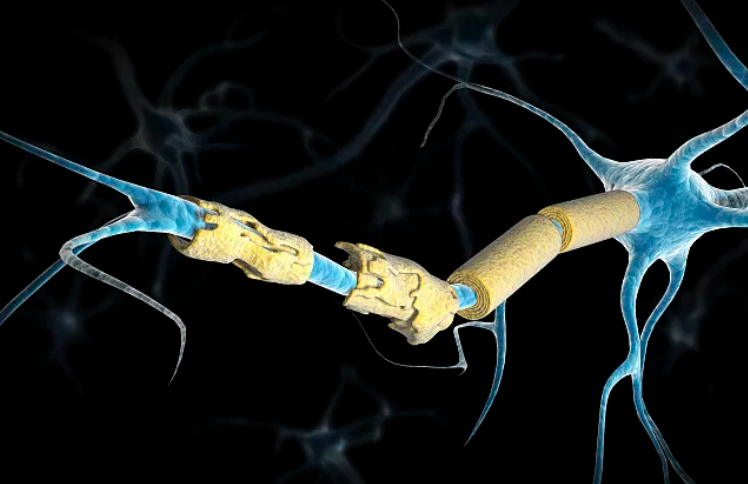 试验显示：干细胞疗法是治疗进展性多发性硬化症的希望