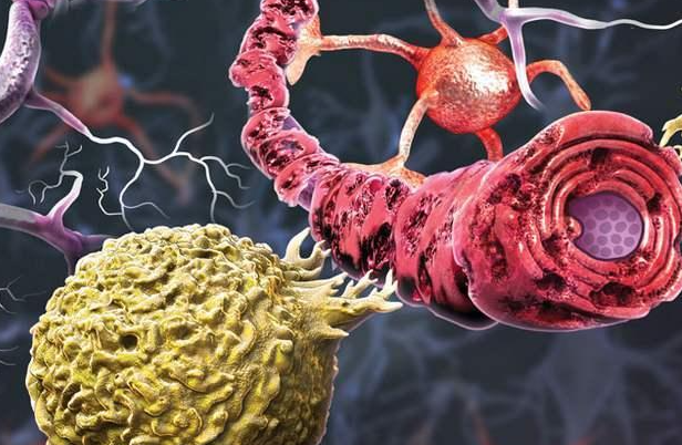 试验显示：干细胞疗法是治疗进展性多发性硬化症的希望