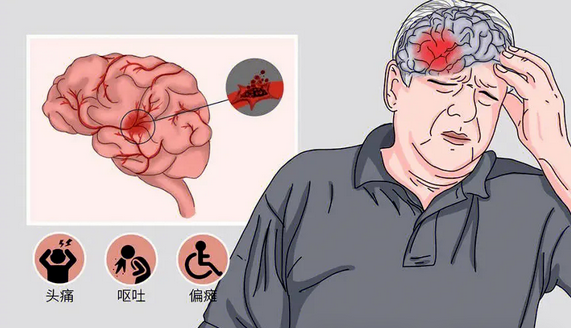 干细胞移植治疗脑卒中，60例患者均取得满意效果