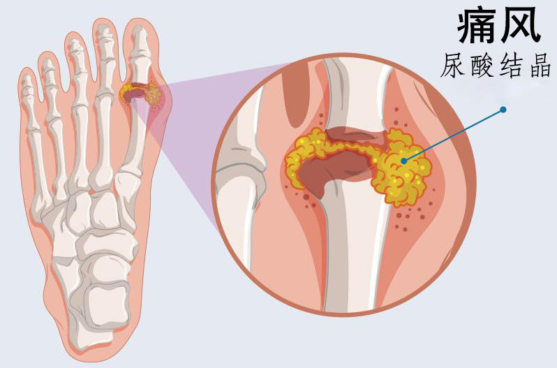 免疫细胞治疗痛风的相关案例