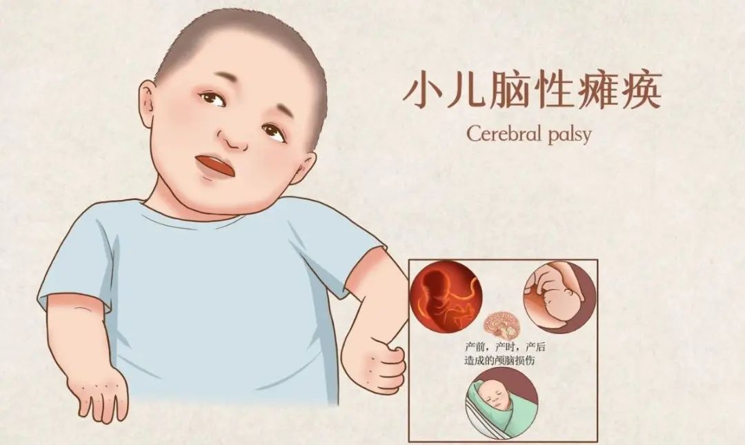 通过鼻腔内神经干细胞（NSC）移植治疗脑瘫的一项研究报告