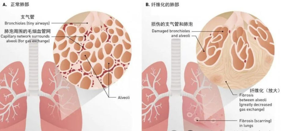 关于干细胞治疗肺纤维化的5个临床研究案例