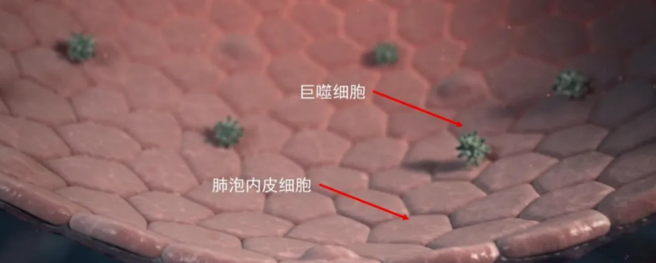 关于干细胞治疗肺纤维化的5个临床研究案例