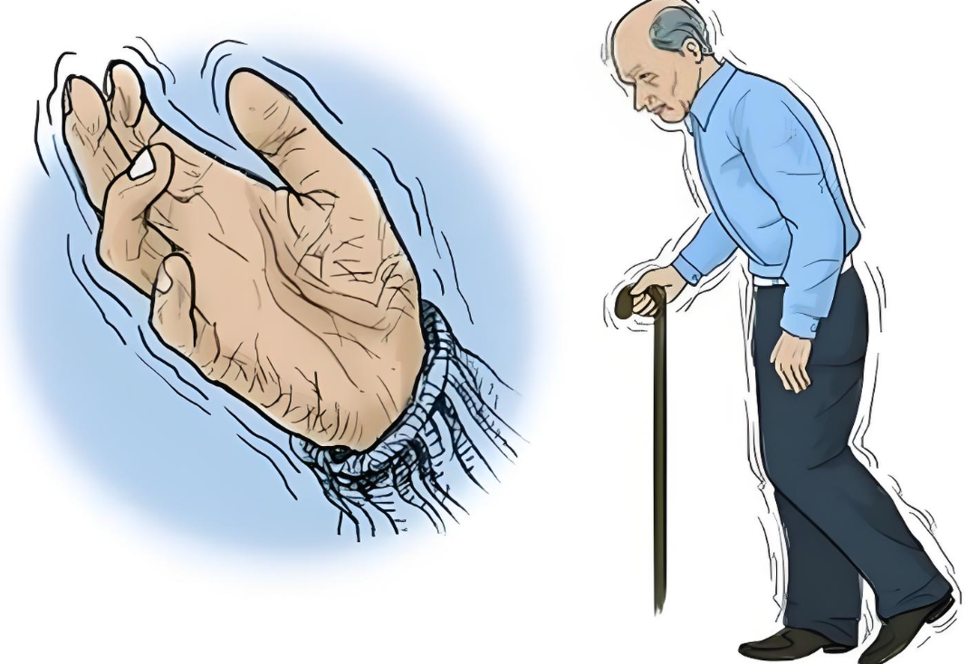 干细胞创新疗法助力帕金森病患者