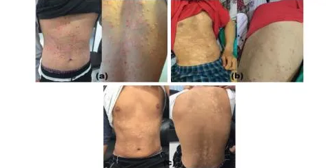 一项关于间充质干细胞治疗银屑病的相关案例报道