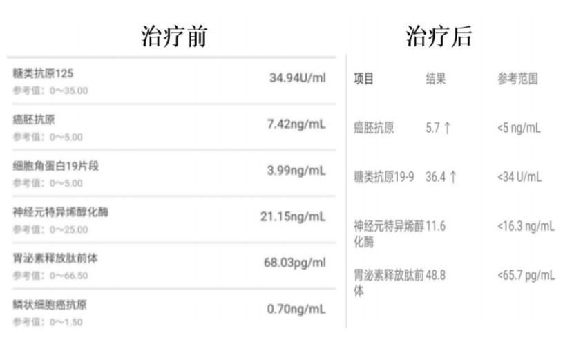 被称为免疫细胞中“特种兵”的NKT细胞有何独特之处