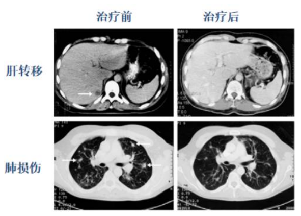 被称为免疫细胞中“特种兵”的NKT细胞有何独特之处