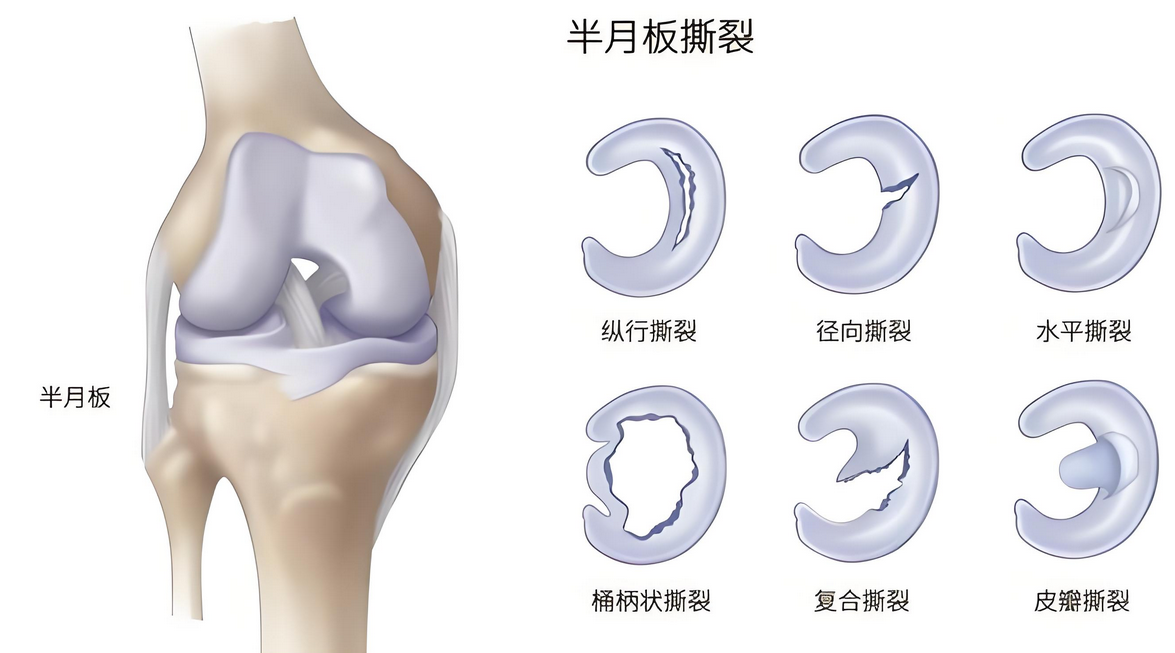 半月板损伤或许不用切除，多项研究案例表明干细胞可修复半月板损伤