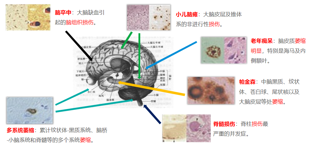 神经干细胞(NSC)预防大脑重症、抵抗衰老