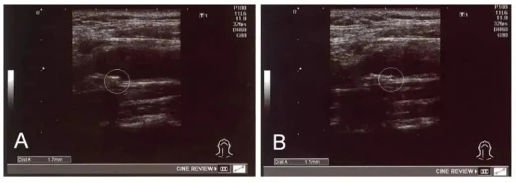干细胞助您远离“三高”风险！