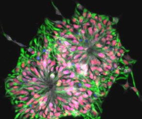 诱导多能干细胞（iPSC）在疾病中的应用