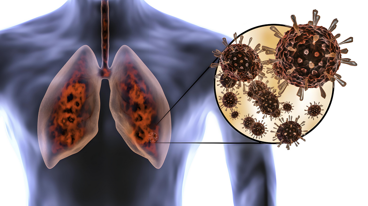 研究表明：间充质干细胞(MSC)可有效改善流感病毒感染和肺损伤