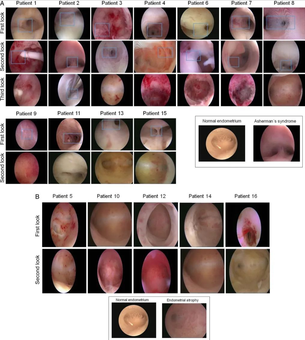 干细胞在女性不孕症中的研究应用